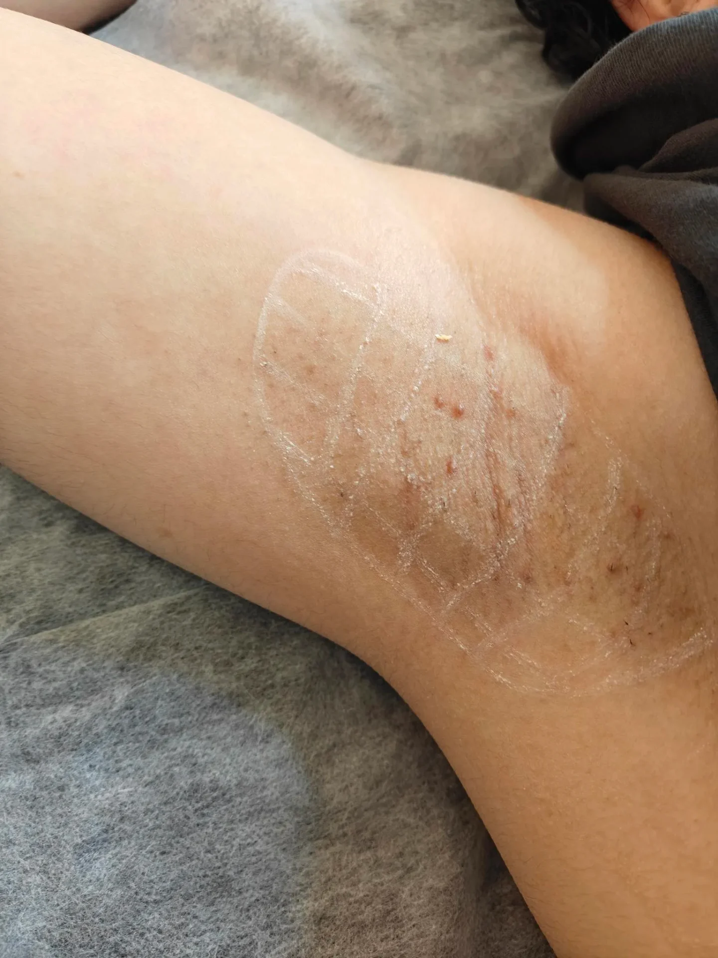 Resultat av medicinsk Botox-behandling hos Hanoshe Klinik
