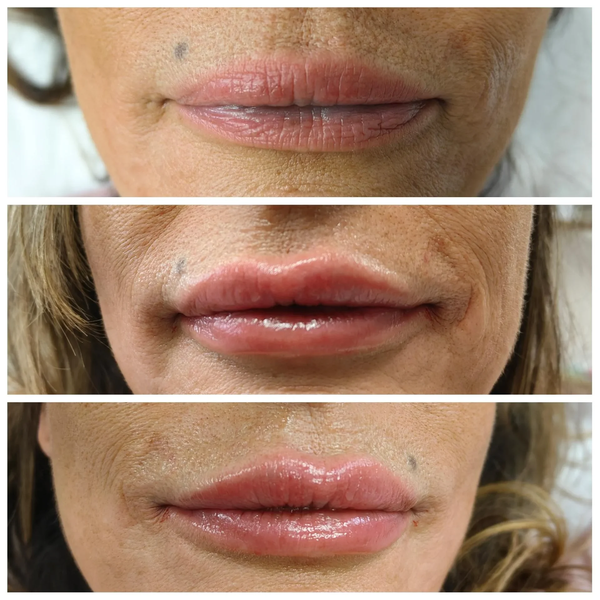 Naturligt resultat efter läppfiller hos Hanoshe Klinik